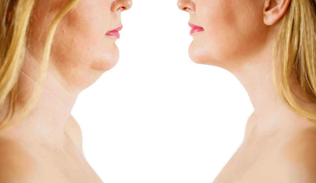Double Chin treatment East Sussex before and after results