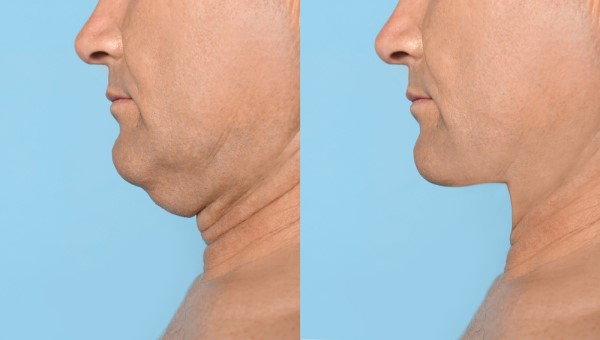 Which Non-Surgical Treatments Work Best for Jowls and Loose Skin East Sussex?
