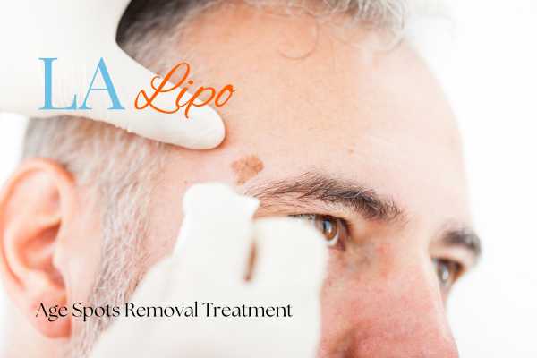 What Are the Most Effective Treatments for Age Spots East Sussex?
