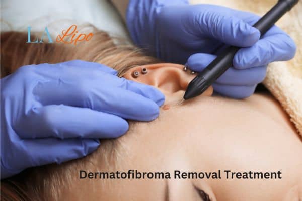 Dermatofibroma Removal Treatment East Sussex