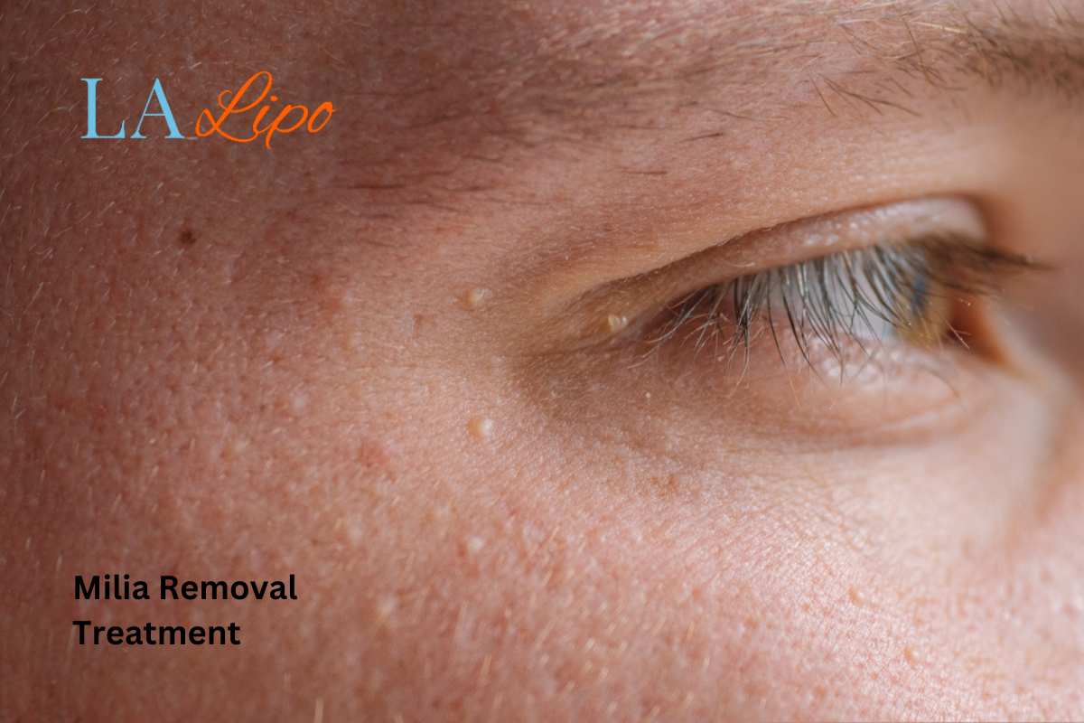 Cryopen Milia Removal: Is It the Easiest and Safest Option East Sussex?