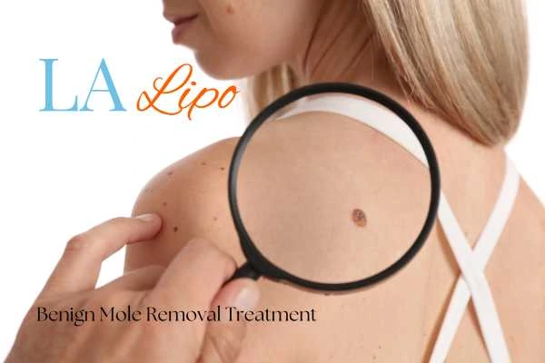 Woman having her inspection of blemish before mole removal East Sussex