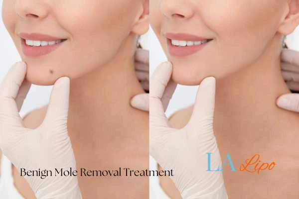 woman's before and after mole removal East Sussex results