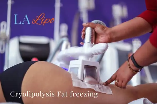 women getting fat freezing East Sussex