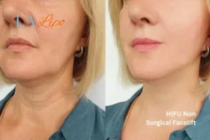 hi-fu for wrinkles East Sussex before and after results