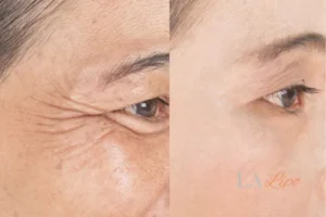 Before and after results of woman - HI-fu wrinkles reduction treatment East Sussex