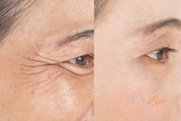 Before and after results of woman - HI-fu wrinkles reduction treatment East Sussex