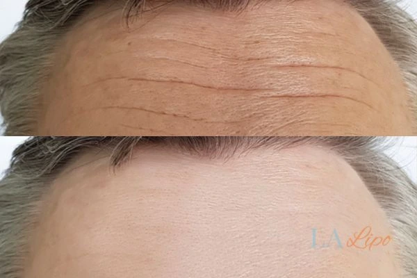 results of HIFU East Sussex on mans forehead to help reduce lines and wrinkles