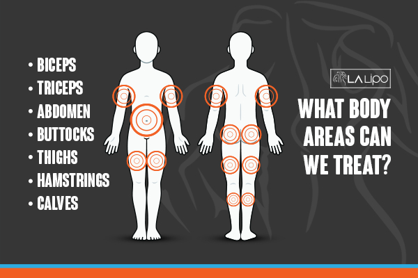 Graphic to show areas you can have LA-EMS Body Sculpting East Sussex treatment.