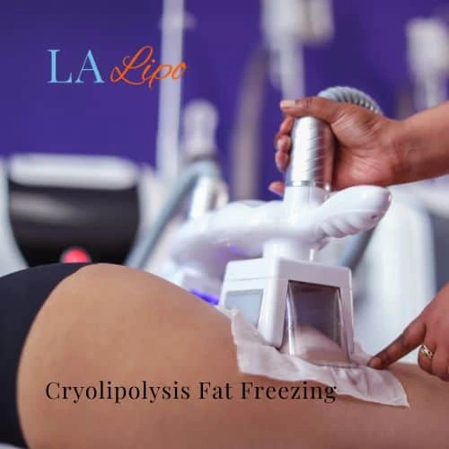 fat freezing - Cryolipolysis East Sussex