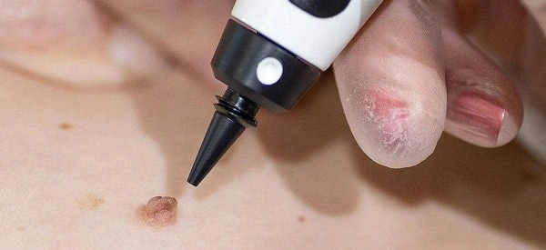 skin tag removal using cryopen East Sussex