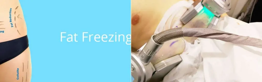 Fat freezing East Sussex on multiple areas of the body