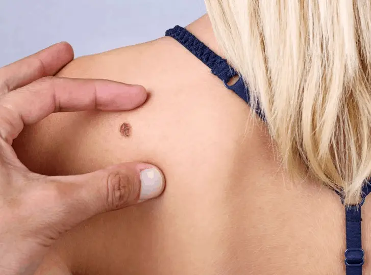 woman having mole removal East Sussex consultation before treatment.
