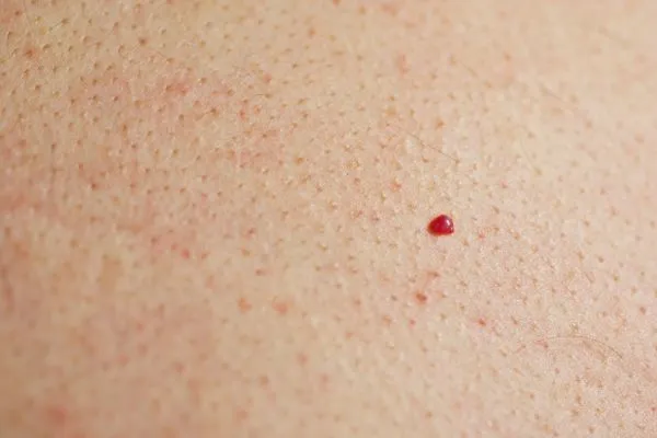 close up of a cherry angioma East Sussex