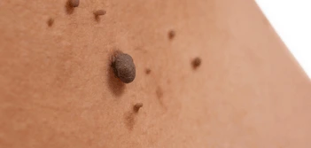 image of a skin tag East Sussex