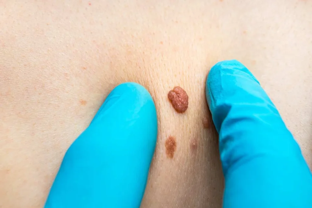 Consultant examining a skin tag East Sussex