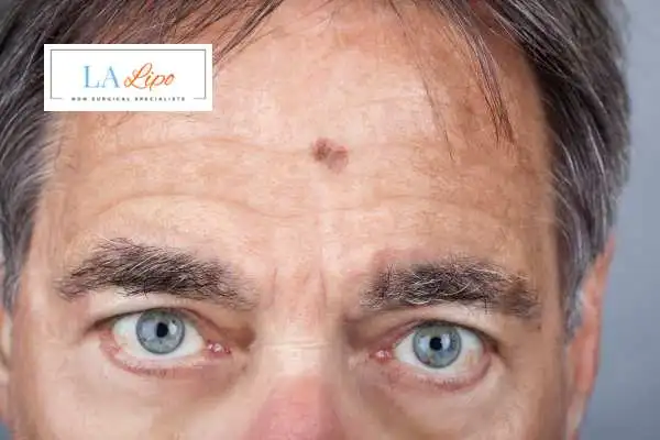 Solar Lentigo Removal East Sussex image of man with mark on his forehead
