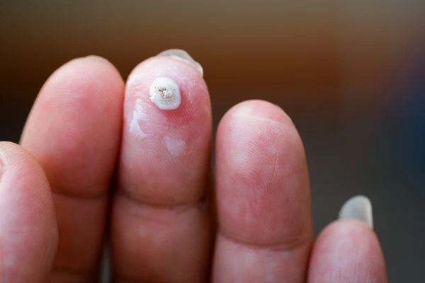 wart on person finger - cryotherapy to treat from LA LIPO East Sussex