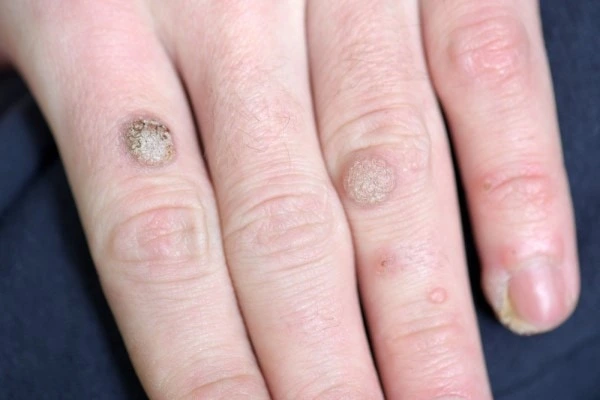 photo of warts on person hand - see wart removal East Sussex from LA LIPO