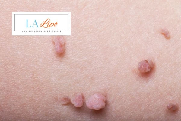Does cryopen skin tag removal East Sussex hurt? Find out now call our team today!