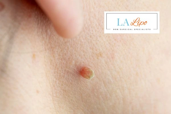 Book skin tag removal East Sussex today speak to our team now!
