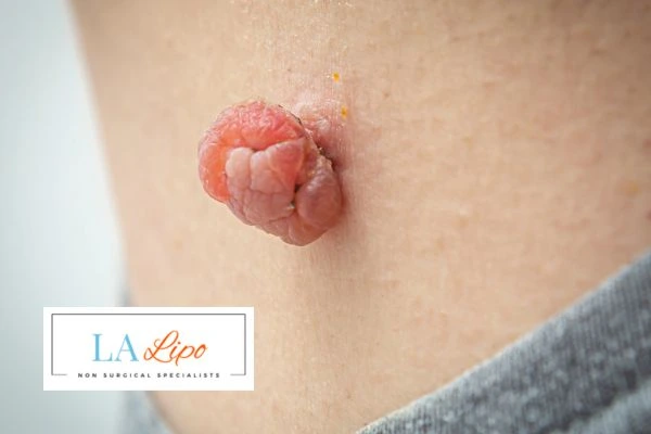 Interested in skin tag removal East Sussex? Concerned about the pain? Find out more today!