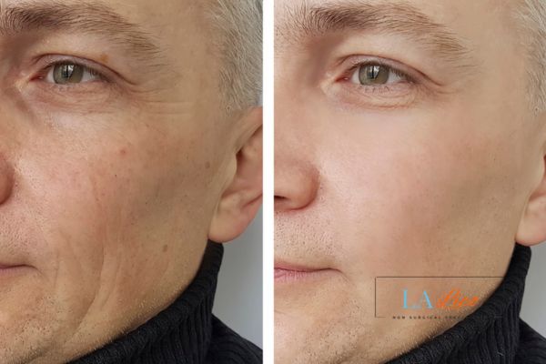 See the amazing results of Morpheus8 Treatment East Sussex!
