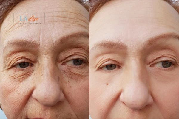 The powerful benefits of Morpheus8 Treatment East Sussex - Call Our team today!