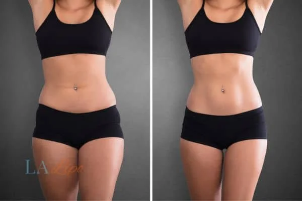 before and after results of non-surgical treatment to help a woman's body image and mental health East Sussex