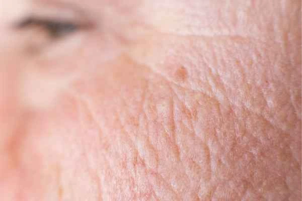 close up picture of a woman's face showing an age spot East Sussex