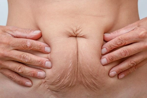 Image of a woman's stomach with loose skin - example of skin tightening East Sussex options
