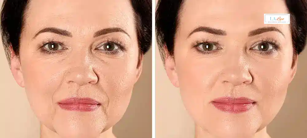 How Long Does It Take to See Results and How Long Do They Last East Sussex?