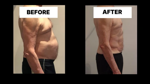 What Symptoms Can Diastasis Recti Cause in Men? Weak Core, Back Pain and Poor Posture East Sussex